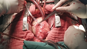 open-heart-surgery